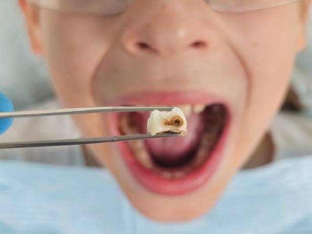 Best Emergency Wisdom Teeth Removal in Ventress, LA